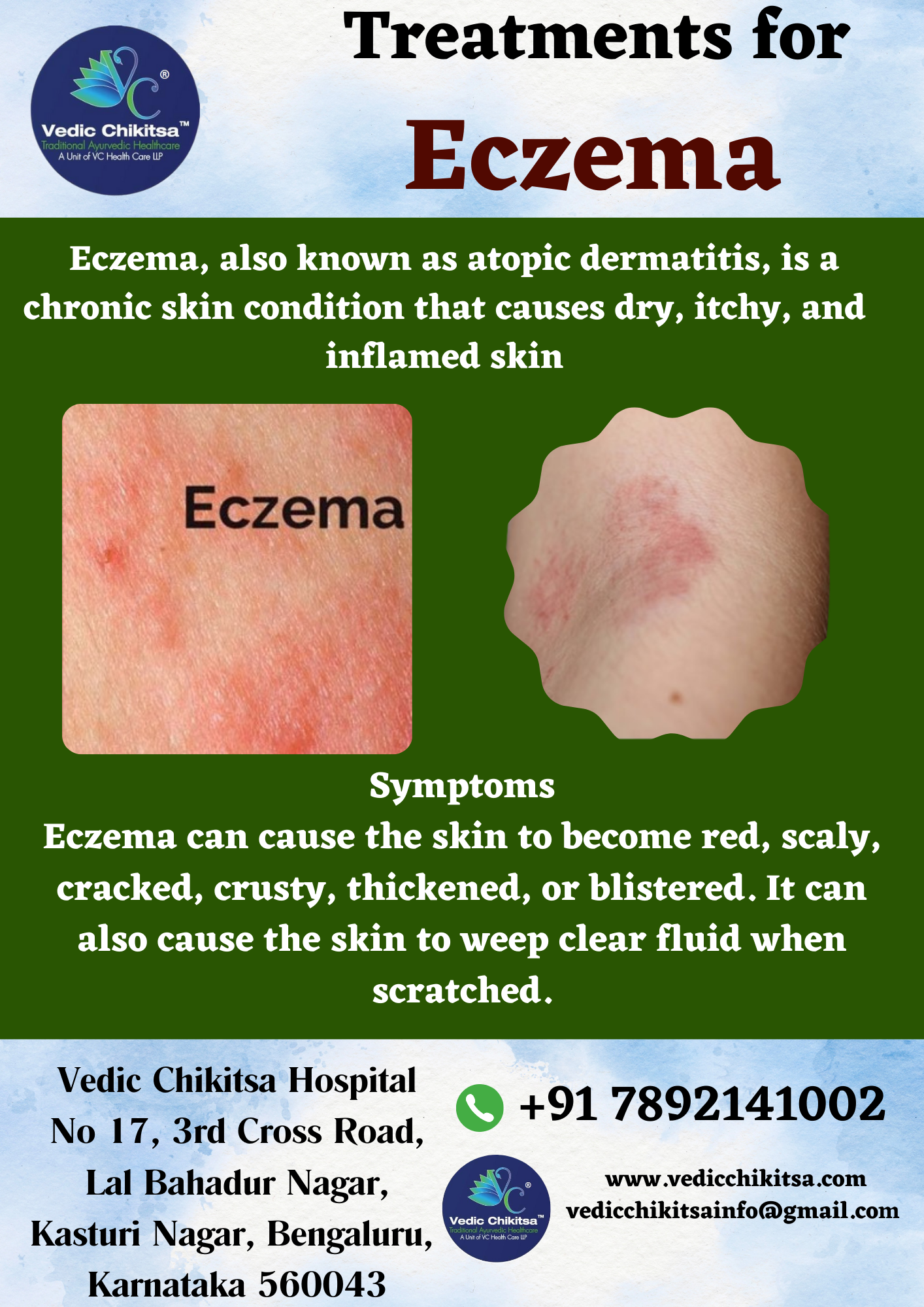 Vedic Chikitsa - Latest update - Eczema Treatments in Banaswadi