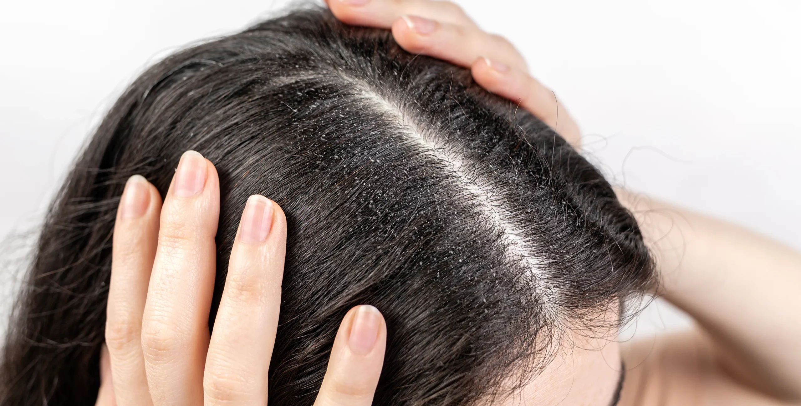 Vedic Chikitsa - Latest update - Dandruff Ayurvedic Treatment In Bangalore