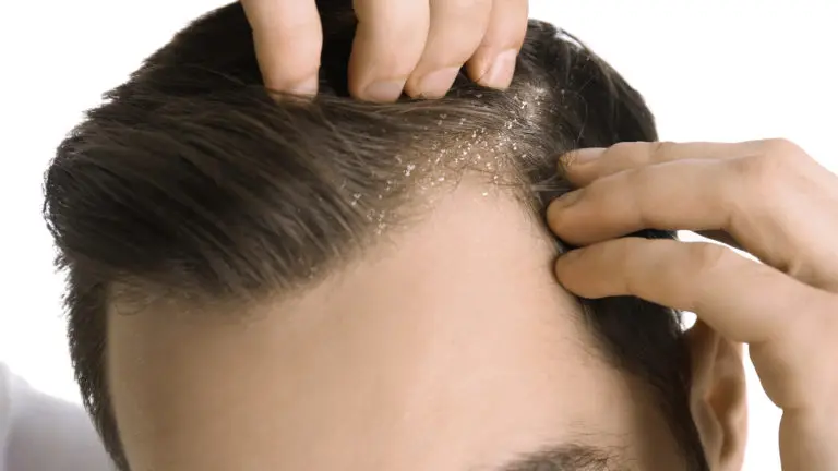 Vedic Chikitsa - Latest update - Dandruff Ayurvedic Treatment In Bangalore