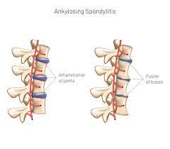 Vedic Chikitsa - Latest update - Spondylitis ayurvedic treatment in Banaswadi