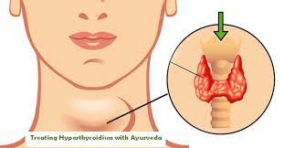 Vedic Chikitsa - Latest update - Hyperthyroidism ayurvedic treatment in Bangalore