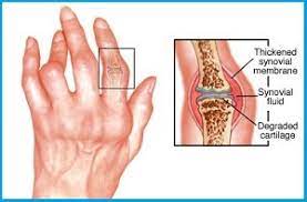 Vedic Chikitsa - Latest update - Rheumatoid arthritis ayurvedic treatment in Banasawadi