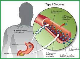 Vedic Chikitsa - Latest update - Diabetes Ayurvedic Treatment in Bangalore