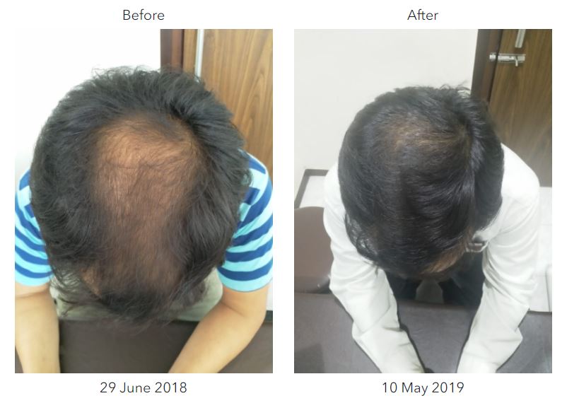 Vedic Chikitsa - Latest update - Hair Fall Ayurvedic Treatment In Bangalore