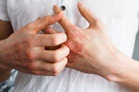 Vedic Chikitsa - Latest update - Eczema ayurvedic treatment in Bangalore