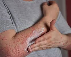 Vedic Chikitsa - Latest update - Eczema Treatments in Bangalore