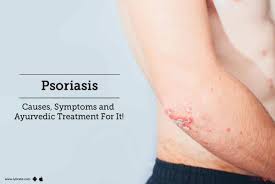 Vedic Chikitsa - Latest update - psoriasis ayurvedic treatment in Bangalore