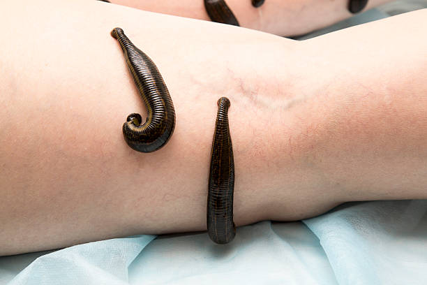 Vedic Chikitsa - Latest update - Best Leech Therapy in Kalyan Nagar